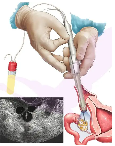 长沙哪有代怀的 长沙市妇幼保健院可以借卵做供卵试管吗 ‘孕囊内径看男女’